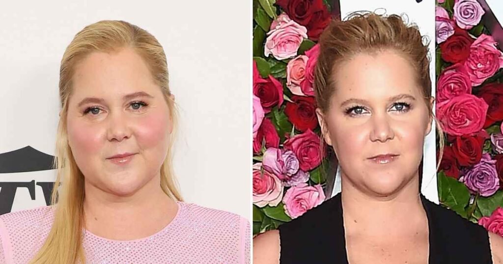 Amy Schumer Discovers She Has Cushing Syndrome Thanks to Online Trolls