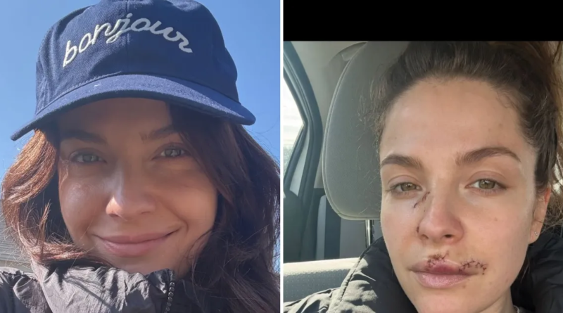 Paige Spara from The Good Doctor Shares Update on Dog Attack Injury