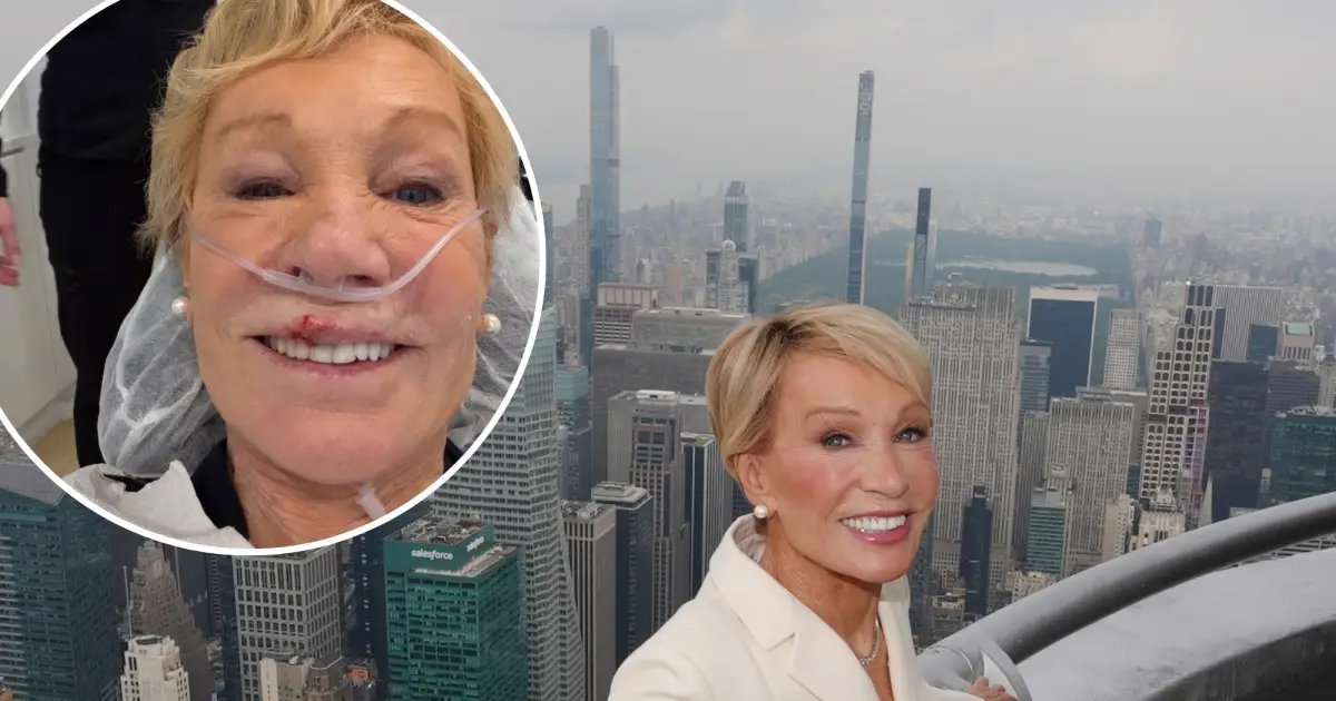 Barbara Corcoran Reveals Aftermath of Broken Tooth and Split Lip