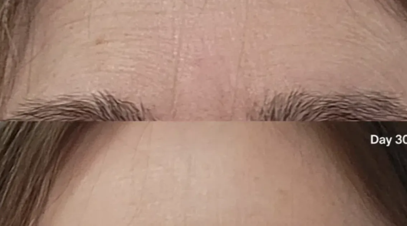 Say Goodbye to Frown Lines: A 3-Minute Solution to Look Years Younger!