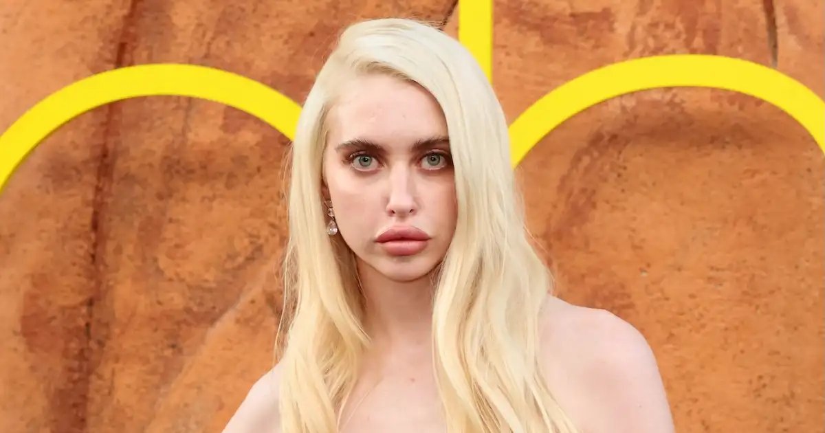 Chloe Cherry from Euphoria Shares Her Experience with Lip Fillers