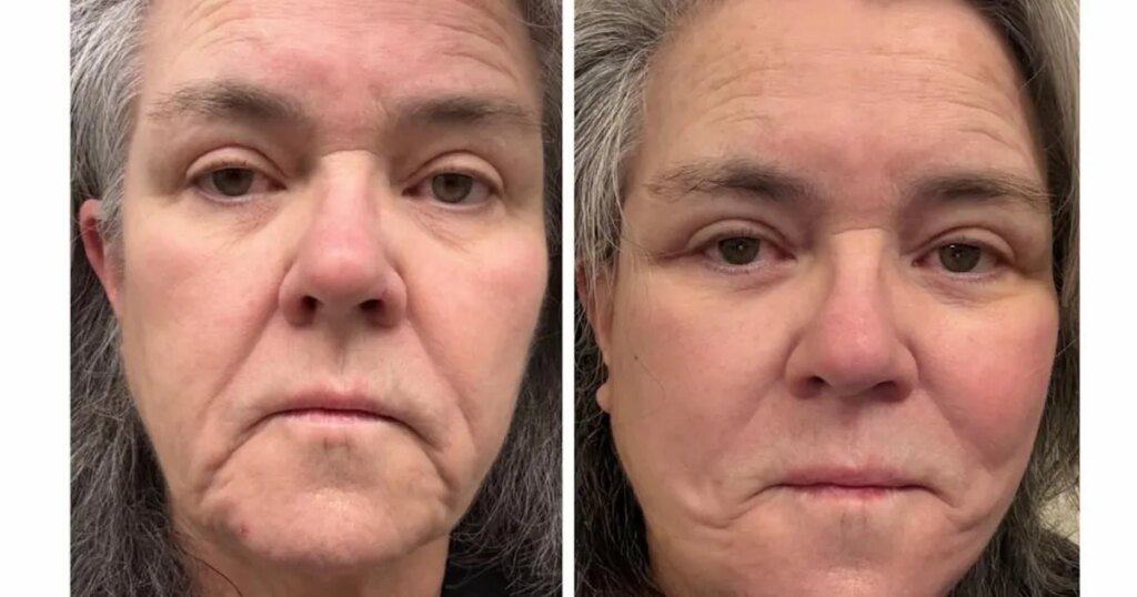 Rosie O'Donnell Reveals Before-and-After Images of Her Facelift