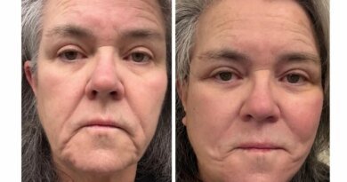 Rosie O'Donnell Reveals Before-and-After Images of Her Facelift