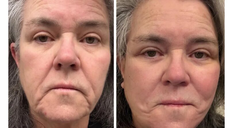 Rosie O'Donnell Reveals Before-and-After Images of Her Facelift