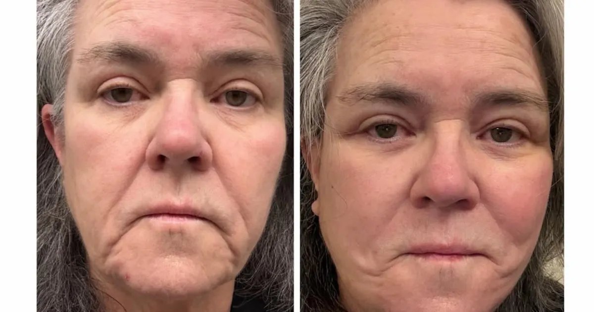 Rosie O’Donnell Reveals Before-and-After Images of Her Facelift